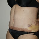 1 Week post-op