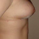 3 Week Post-Op- Left Side