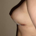 3 Week Post-Op- Right Side
