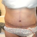 Post op day 9
Front