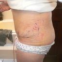 Post op day 9
Left side
