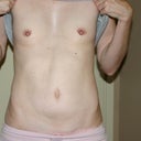 This is the morning of surgery. I should have taken pictures last night to show a good contrast.