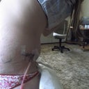 side view.....  You can see the swelling.