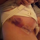 New bruise
Looks bad but not really painful.