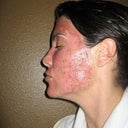 Day 4- you can see the dry darker skin has flaked off; early in day