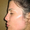 Day 11 - can see the blotchiness and redness