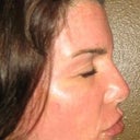 Day 6- all shedding gone... Broken capillary on cheek where skin got too dry