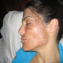 The day of procedure at home
