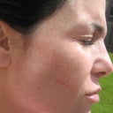 Day 24... look around forehead for "honeycomb" texture... stripes on cheeks.. (Scar from son scratching)