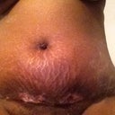 incision started to open up.
