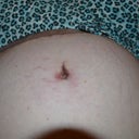 new stretch marks around belly button. 5 wks post