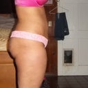 1 day before tummy tuck