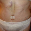 close up you can see some binder marks and a couple of marks under underwear where my drains have been removed and the line of the bandage where the cut is. All dissolveable stiches thank goodness. Quite a bit of bruising.