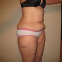 Before surgery-I will not post any after at this time due to the wound 