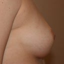 Before profile