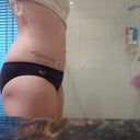 day 6 post op
