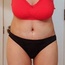 PO day 10 Still hunched over and super swollen, but love what I see so far :)
