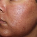 The day after. Skin is starting to show a pattern of dots, which is good!