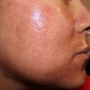 Two days after treatment. Keep the skin well moisturized and don't be alarmed if you get little breakouts!
