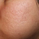 Before my 3rd treatment. These are the types of scars I have.