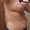 1st shower and look at the bruising