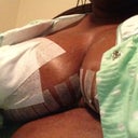 9 days post op :)