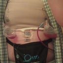 After surgery with drains and pump attached