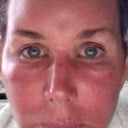 First day after 3rd Fraxal treatment