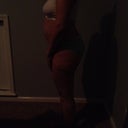 Side view of me before my surgery on Oct 8 2012