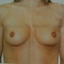 THIS IS MY BEFORE Breast Augmentation PICTURE