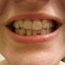 Aligner 10
