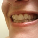 Aligner 10
