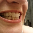 Aligner 10, 1/4 of the way through!