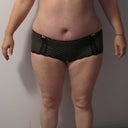 Day 25, Full frontal shot. On May 2nd, few hours before my flight, I saw my PS one last time and he had said I was still very very swollen and I am not much different from last week.