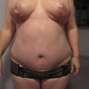 Day 25, close-up of abdominal scar and breast, arms down to show the actual position of the breast.
