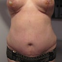 Day 25, close-up of abdominal scar and breast, arms up to compare with the other matching images from prior dates.