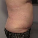 Day 25, my right side