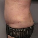 Day 25, my left side