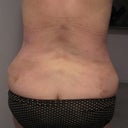 Day 25, my back..you can still see the bruising marks but much better.