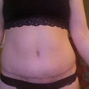 post op day 26, looking better without the adhesive.