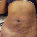 this is day after procedure