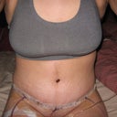 Post Tummy Tuck - Day 7