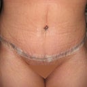 Post Tummy Tuck - Day 13
