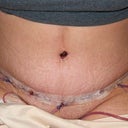 Post Tummy Tuck - Day 5