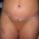 Post Tummy Tuck - Day 9