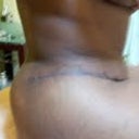 scar from side