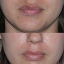 Fraxel Dual to upper lip and brown spots treated.