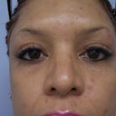 Rhinoplasty