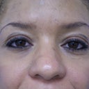 Rhinoplasty