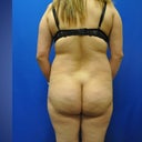 before surgery